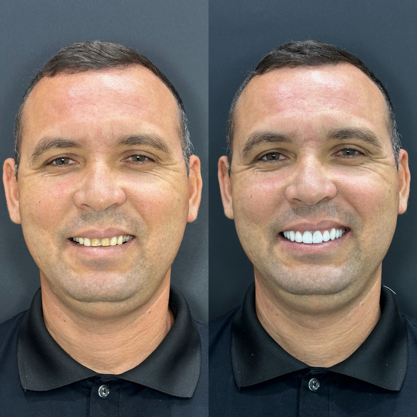 Caso real de implante dentário em São Mateus — Reabilitação com implantes
