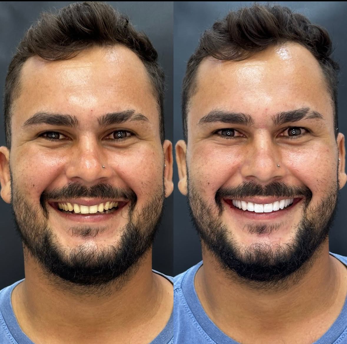 Caso real de implante dentário em São Mateus — Reabilitação estética superior