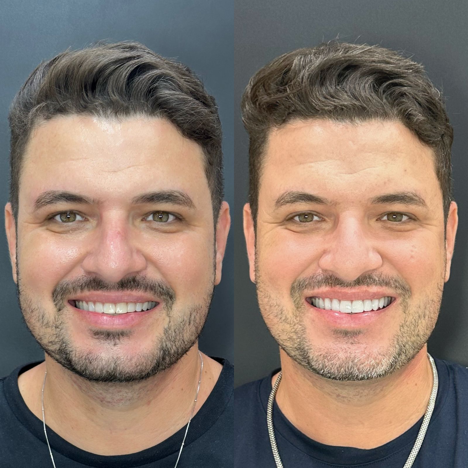 Caso real de implante dentário em São Mateus — Harmonização e reabilitação